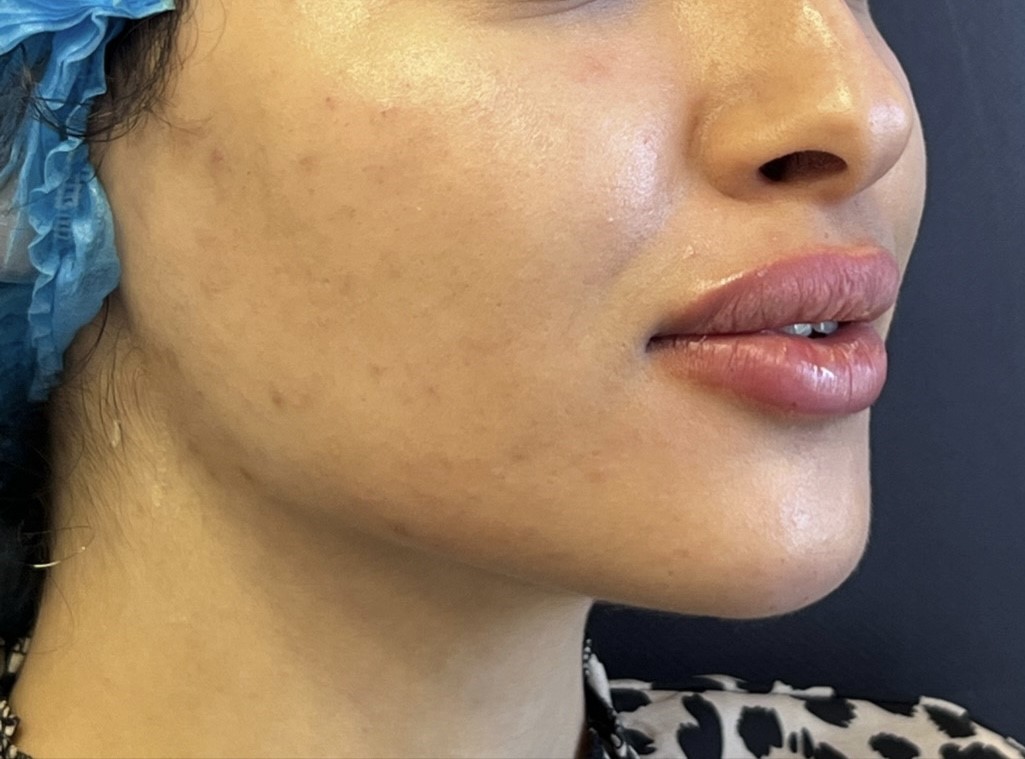 Après full face cas 1