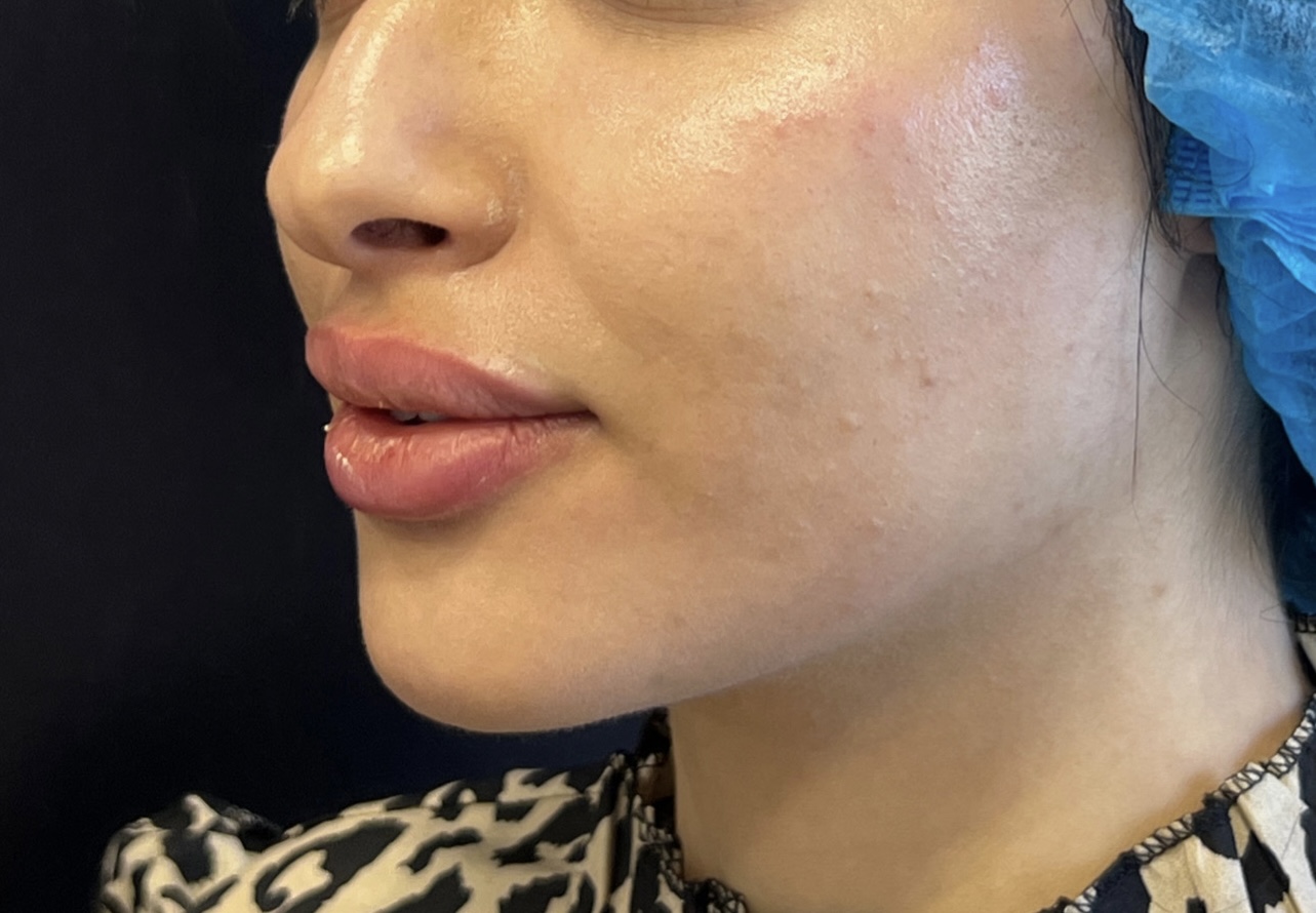 Après full face cas 2