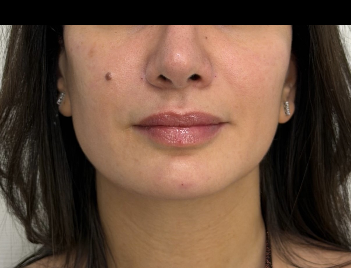 Après full face cas 3