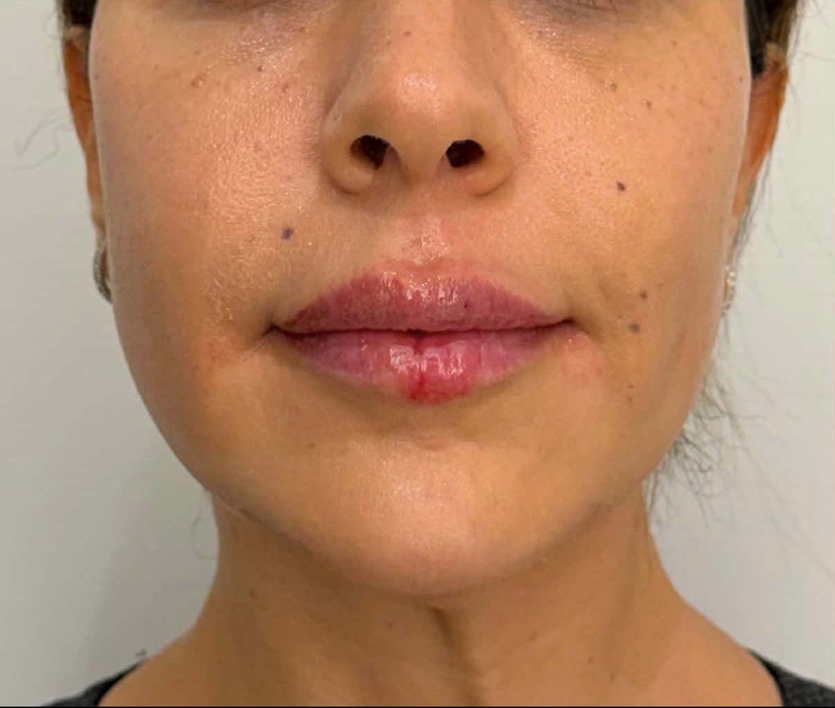 Après full face cas 4