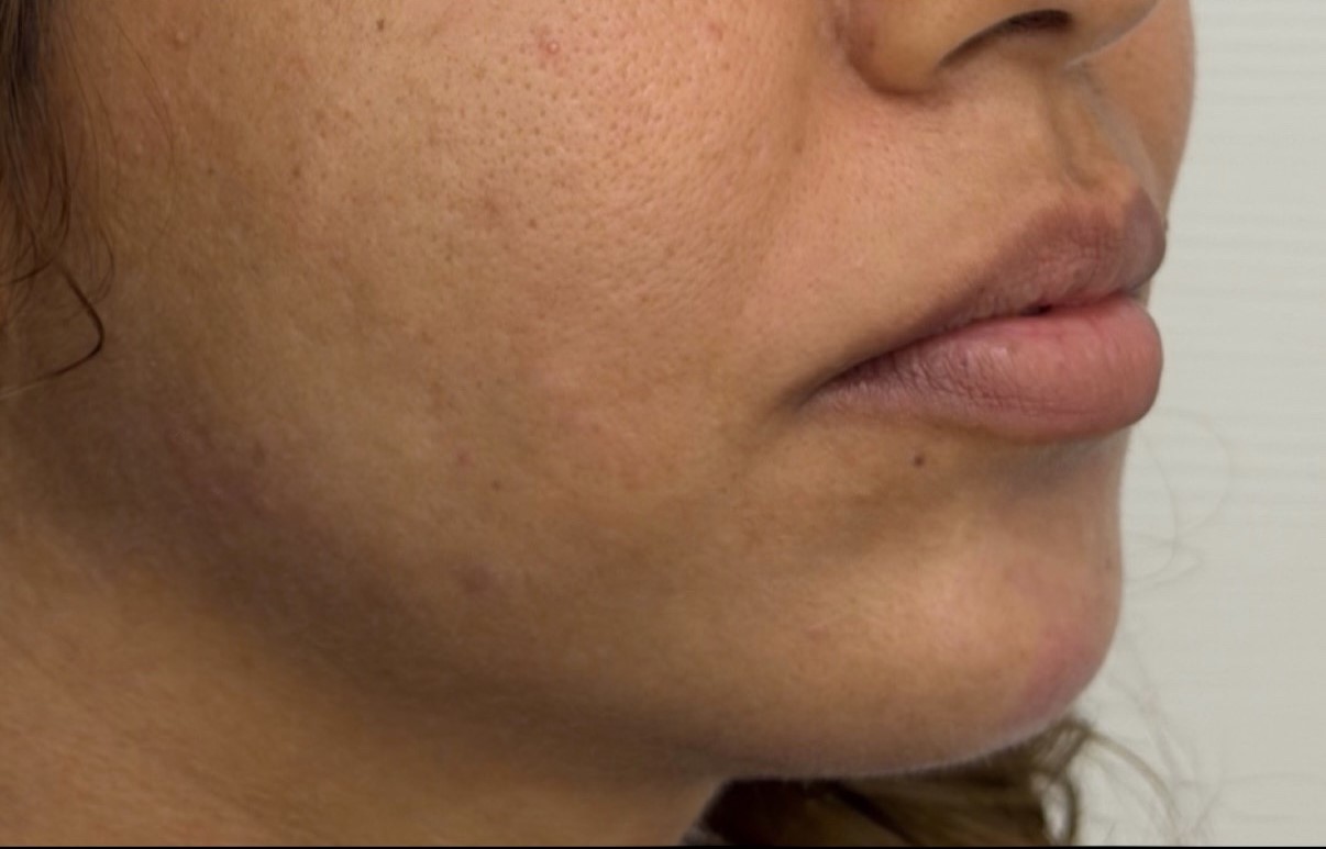 Après jawline cas 3