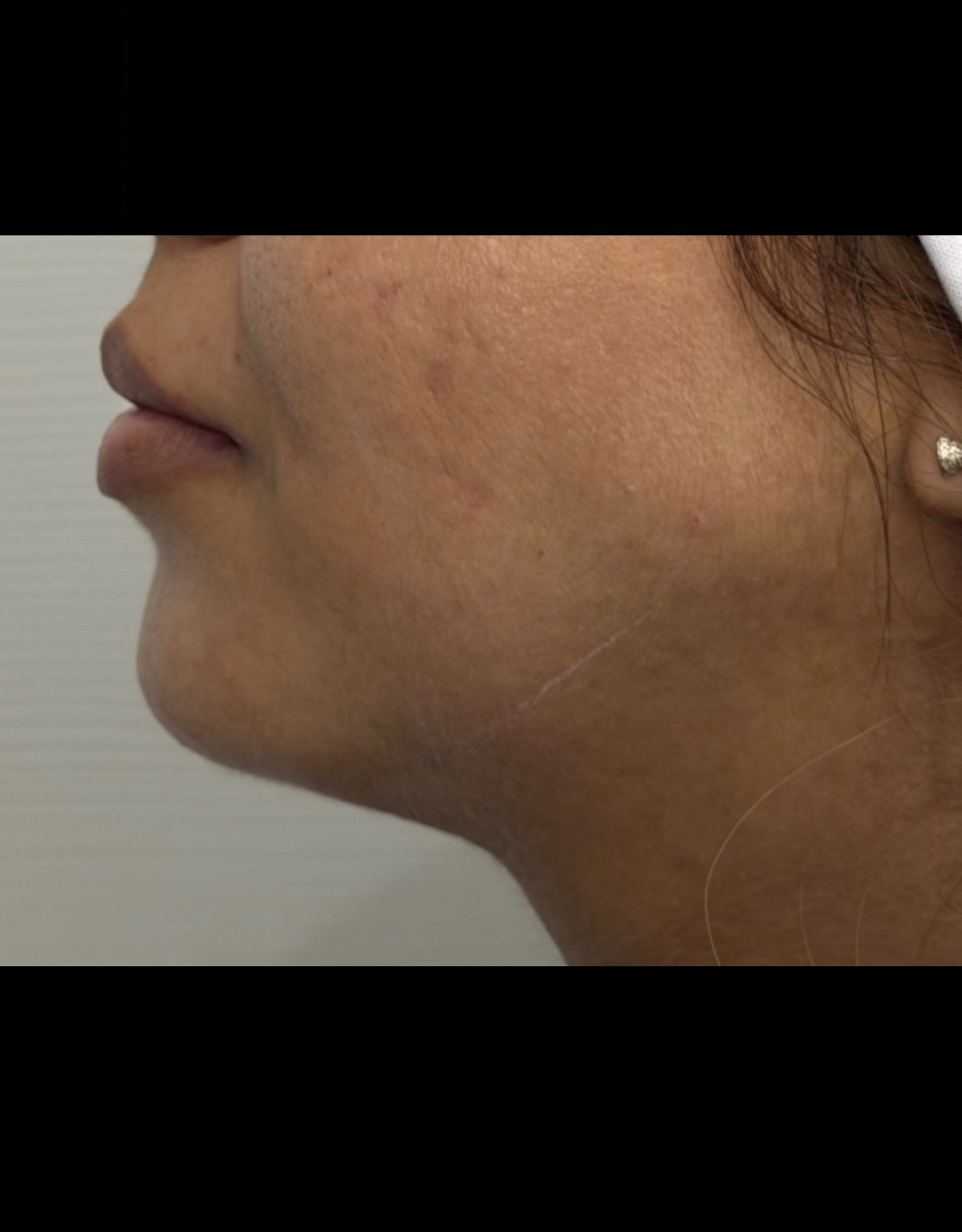 Après jawline cas 4