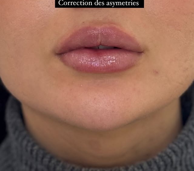 Après lèvres cas 1