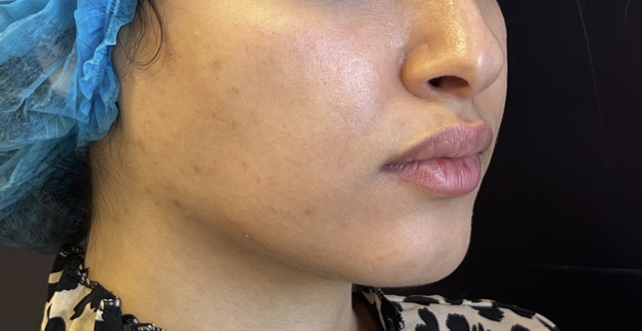 Avant full face cas 1