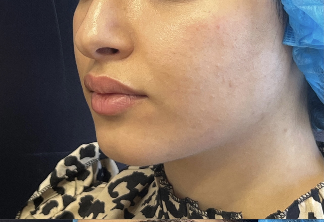 Avant jawline cas 1