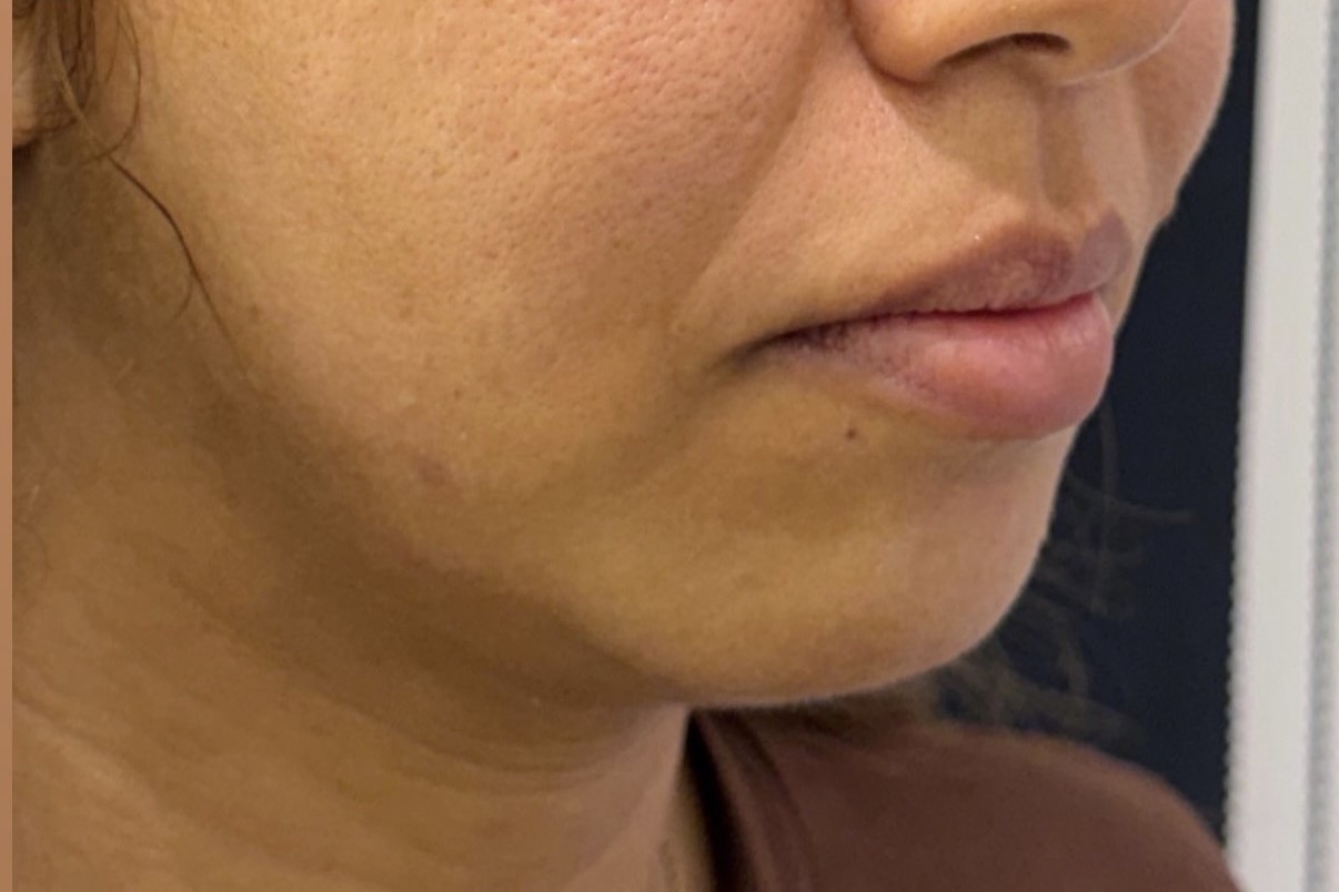 Avant jawline cas 3